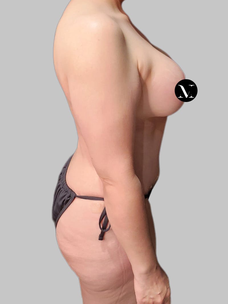 Tummy Tuck Before & After Gallery - Patient 914359 - Image 4