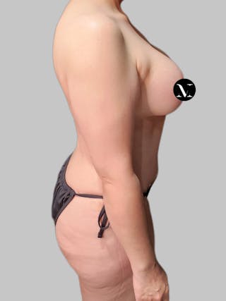 Tummy Tuck Before & After Gallery - Patient 914359 - Image 4