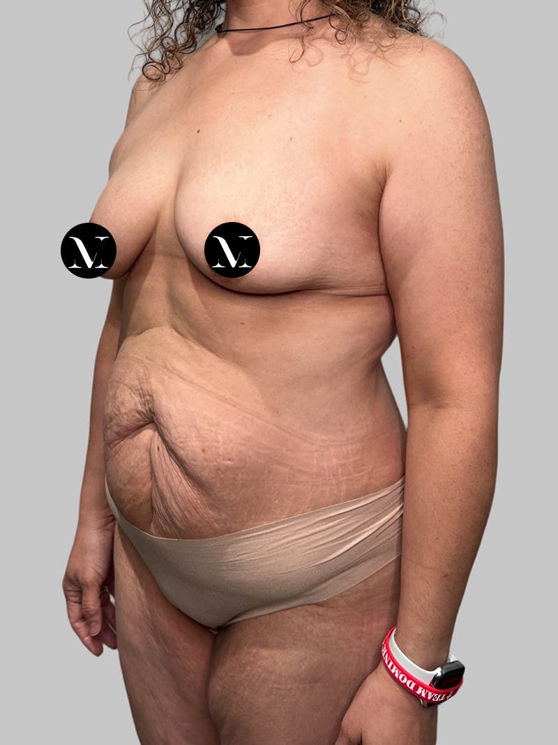 Tummy Tuck Before & After Gallery - Patient 914359 - Image 5