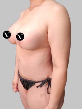 Tummy Tuck Before & After Gallery - Patient 914359 - Image 6