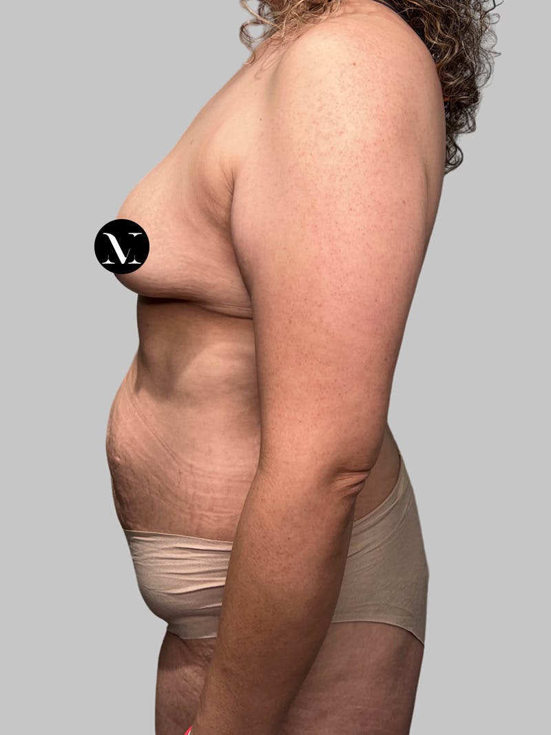 Tummy Tuck Before & After Gallery - Patient 914359 - Image 7