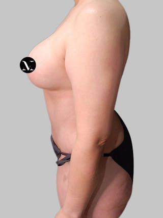 Tummy Tuck Before & After Gallery - Patient 914359 - Image 8