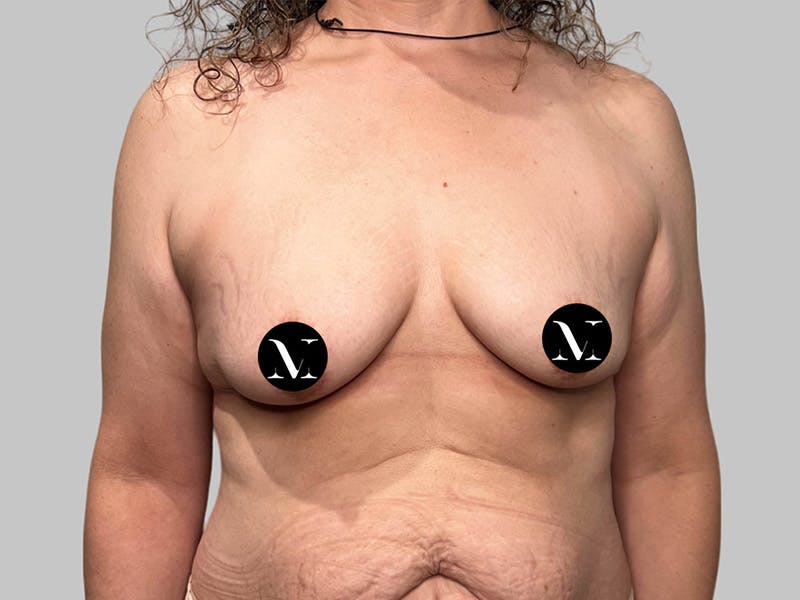 Breast Augmentation-Mastopexy Before & After Gallery - Patient 312970 - Image 1