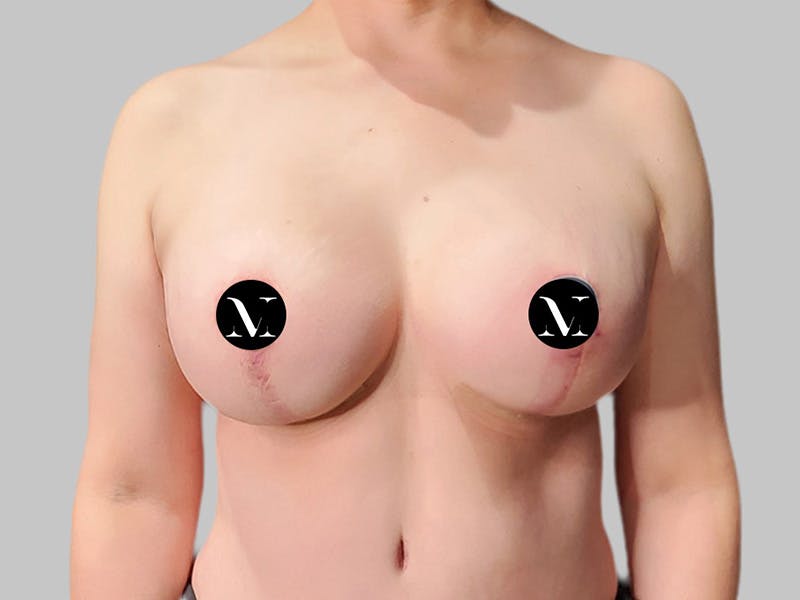 Breast Augmentation-Mastopexy Before & After Gallery - Patient 312970 - Image 2