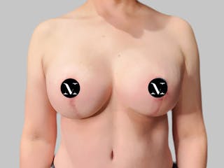 Breast Augmentation-Mastopexy Before & After Gallery - Patient 312970 - Image 2