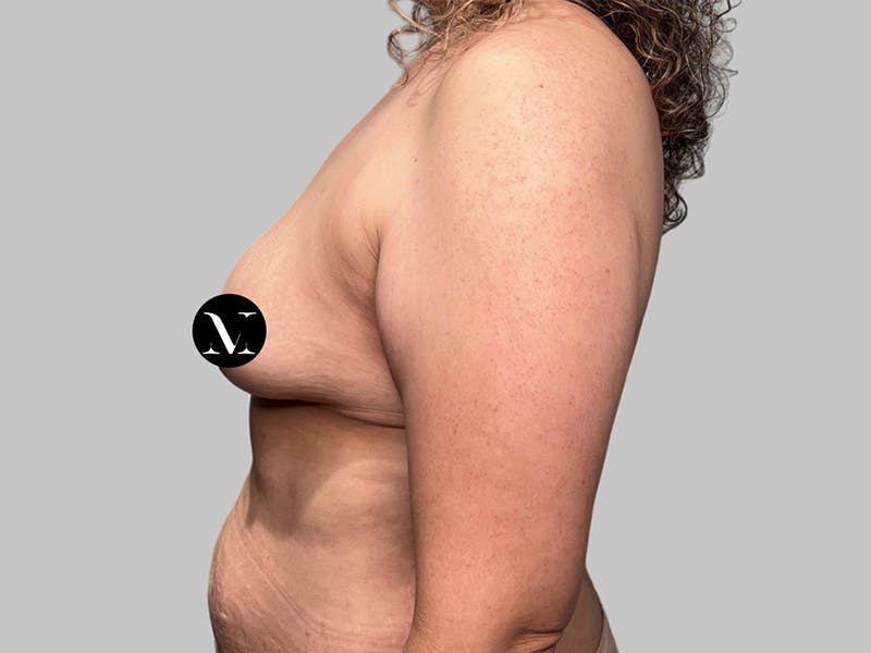 Breast Augmentation-Mastopexy Before & After Gallery - Patient 312970 - Image 7