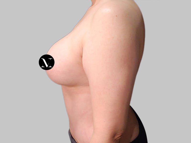 Breast Augmentation-Mastopexy Before & After Gallery - Patient 312970 - Image 8