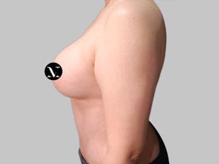 Breast Augmentation-Mastopexy Before & After Gallery - Patient 312970 - Image 8