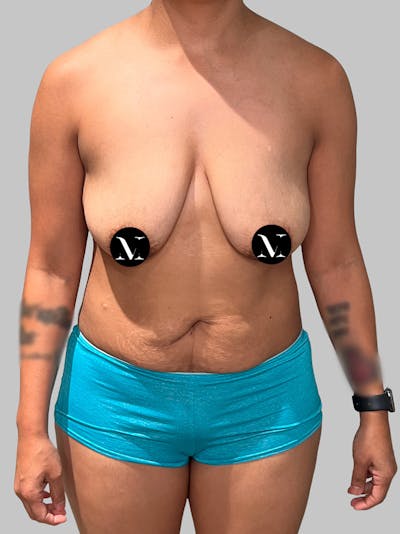 Tummy Tuck Before & After Gallery - Patient 680782 - Image 1