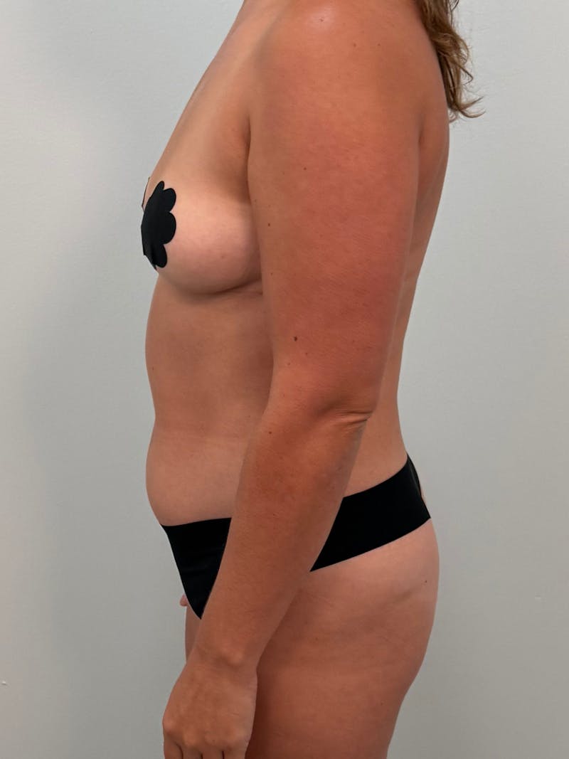 Brazilian Butt Lift Before & After Gallery - Patient 227783 - Image 5