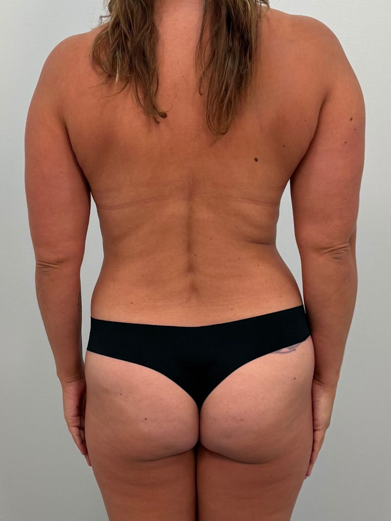 Brazilian Butt Lift Before & After Gallery - Patient 227783 - Image 1