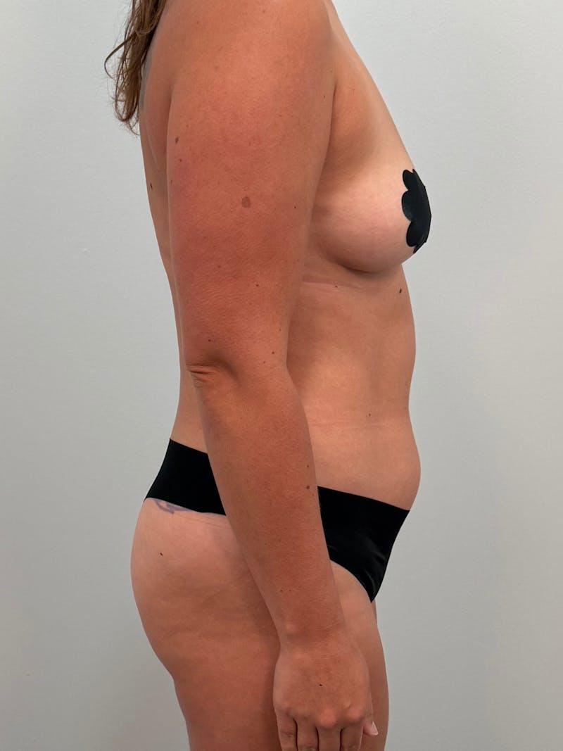 Brazilian Butt Lift Before & After Gallery - Patient 227783 - Image 3