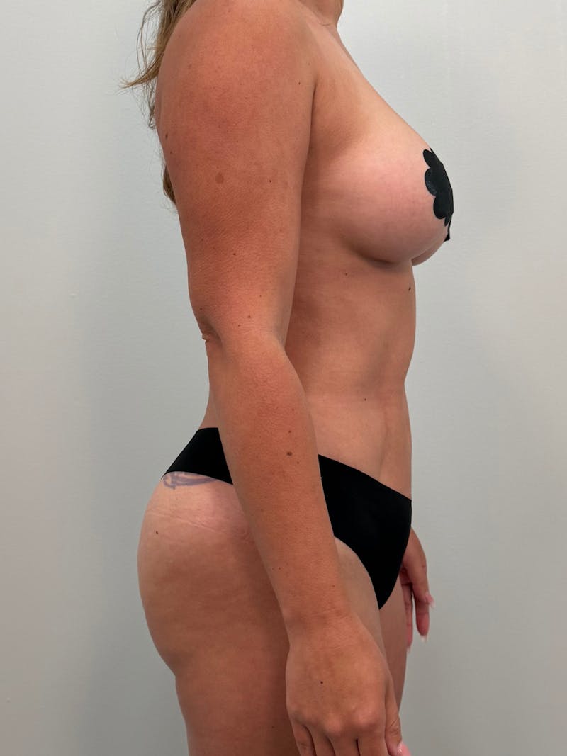 Brazilian Butt Lift Before & After Gallery - Patient 227783 - Image 4