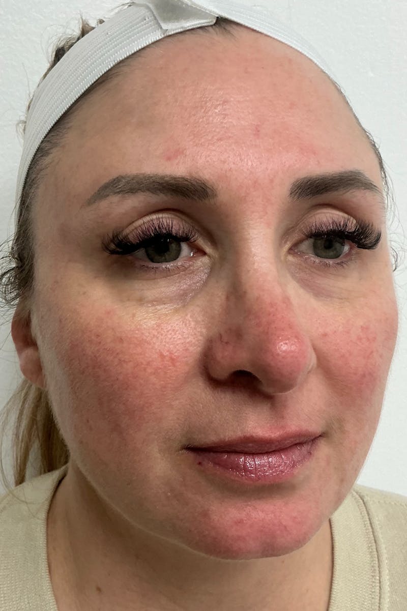 Laser Before & After Gallery - Patient 446883 - Image 1