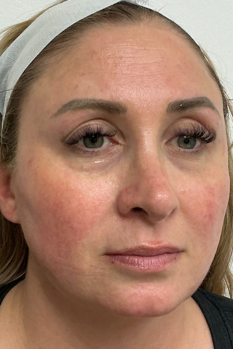 Laser Before & After Gallery - Patient 446883 - Image 2