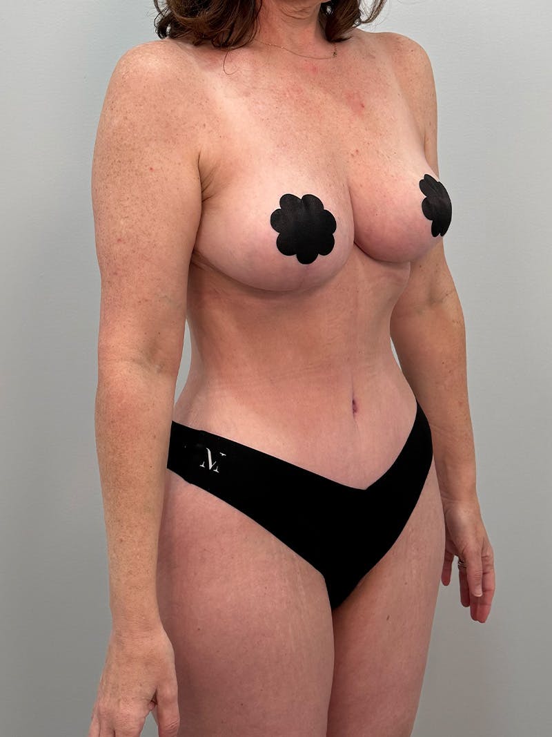 Mommy Makeover Before & After Gallery - Patient 202356 - Image 4