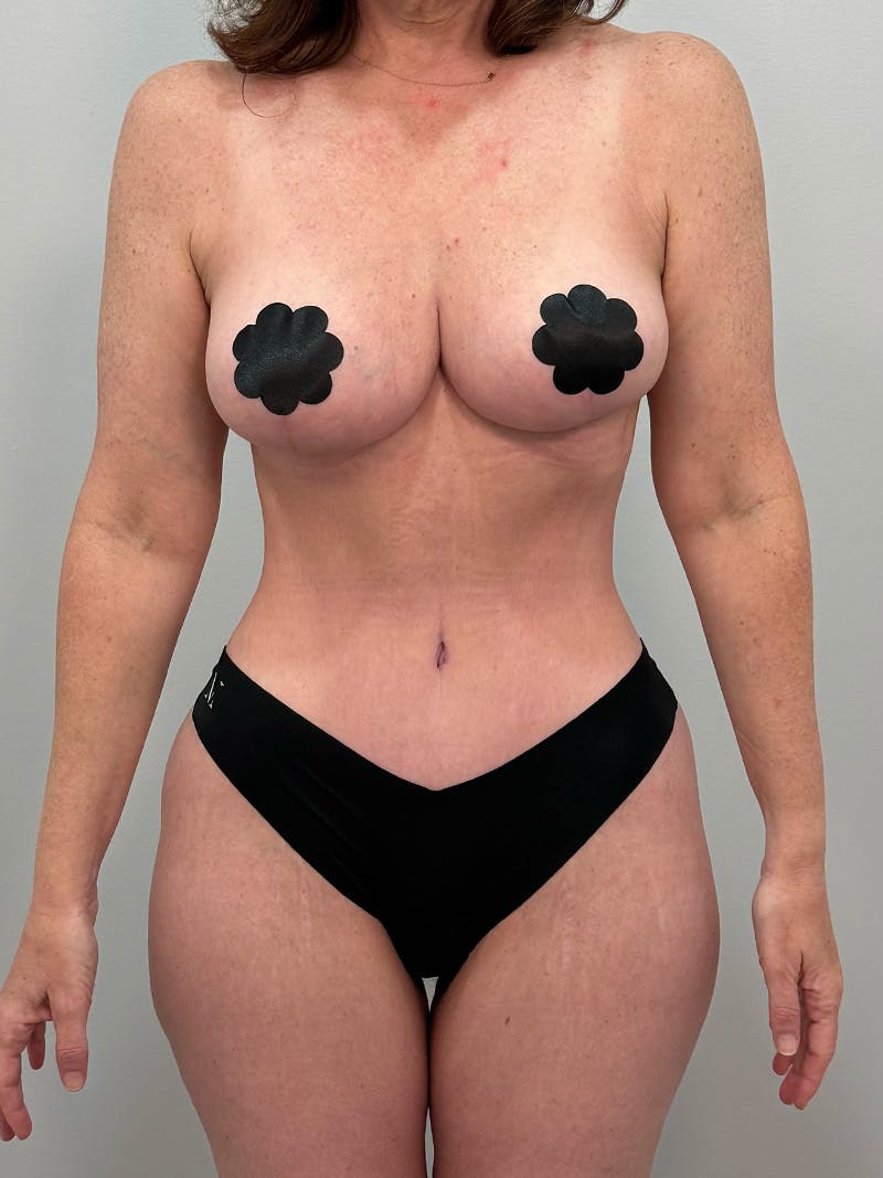 Mommy Makeover Before & After Gallery - Patient 202356 - Image 2