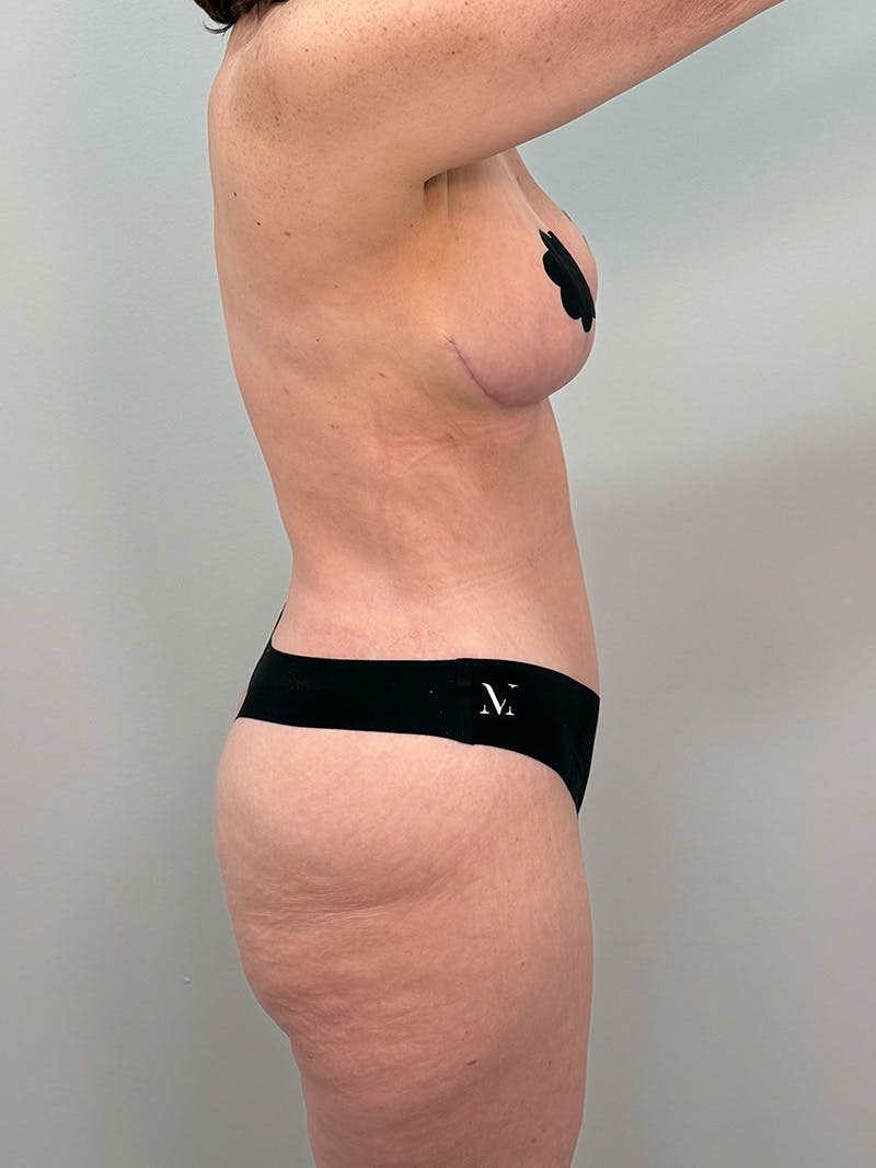 Mommy Makeover Before & After Gallery - Patient 202356 - Image 8