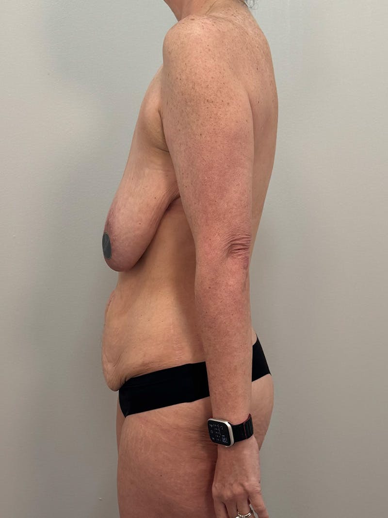 Mommy Makeover Before & After Gallery - Patient 202356 - Image 9