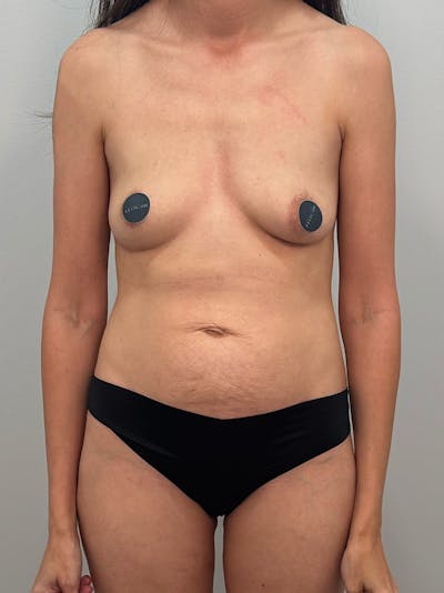 Mommy Makeover Before & After Gallery - Patient 320567 - Image 1