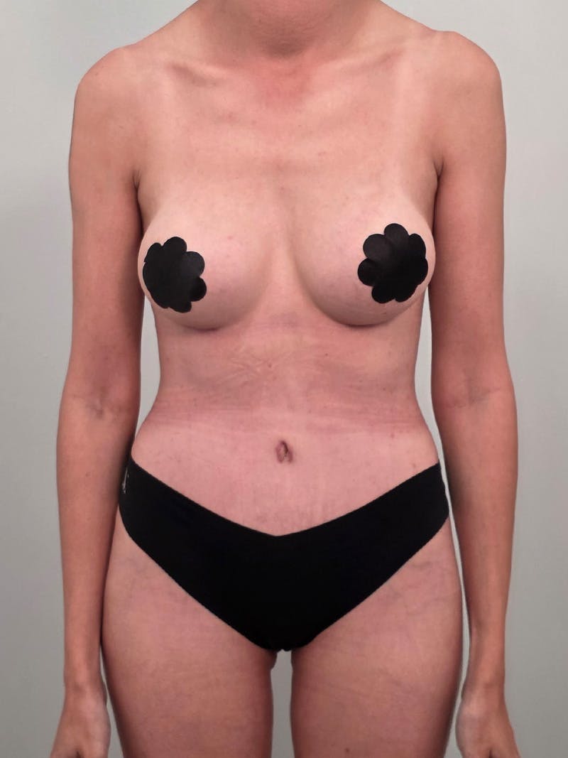 Mommy Makeover Before & After Gallery - Patient 320567 - Image 2