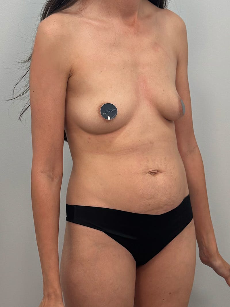 Mommy Makeover Before & After Gallery - Patient 320567 - Image 3