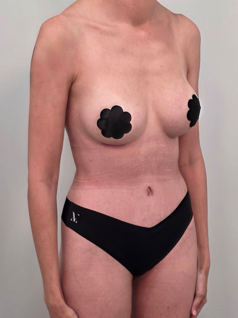 Mommy Makeover Before & After Gallery - Patient 320567 - Image 4