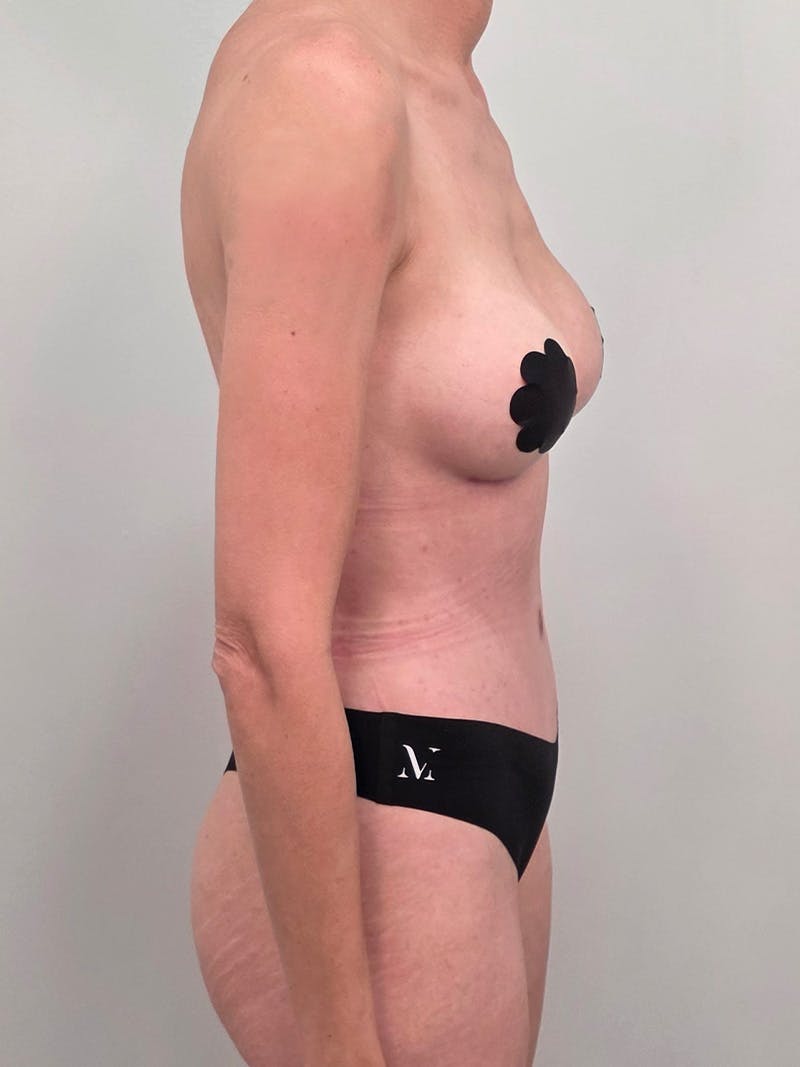 Mommy Makeover Before & After Gallery - Patient 320567 - Image 6