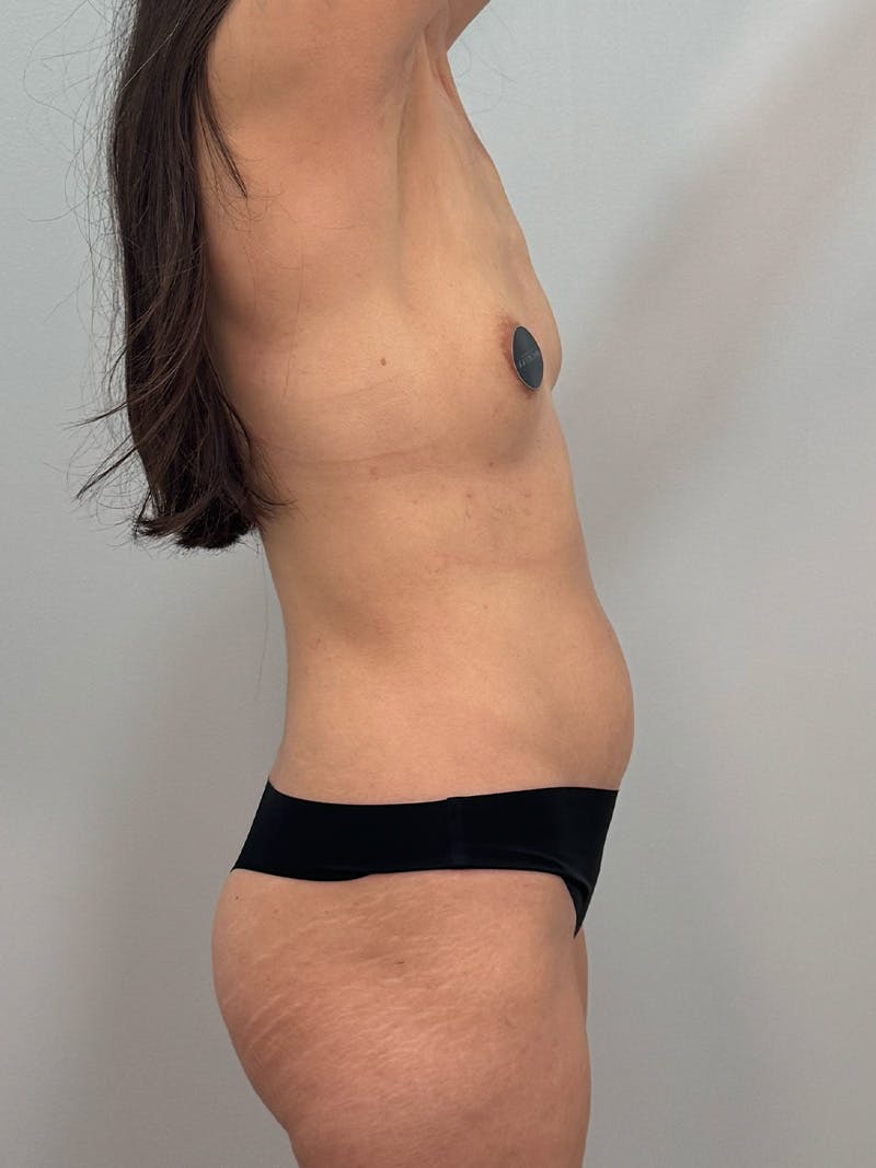 Mommy Makeover Before & After Gallery - Patient 320567 - Image 7