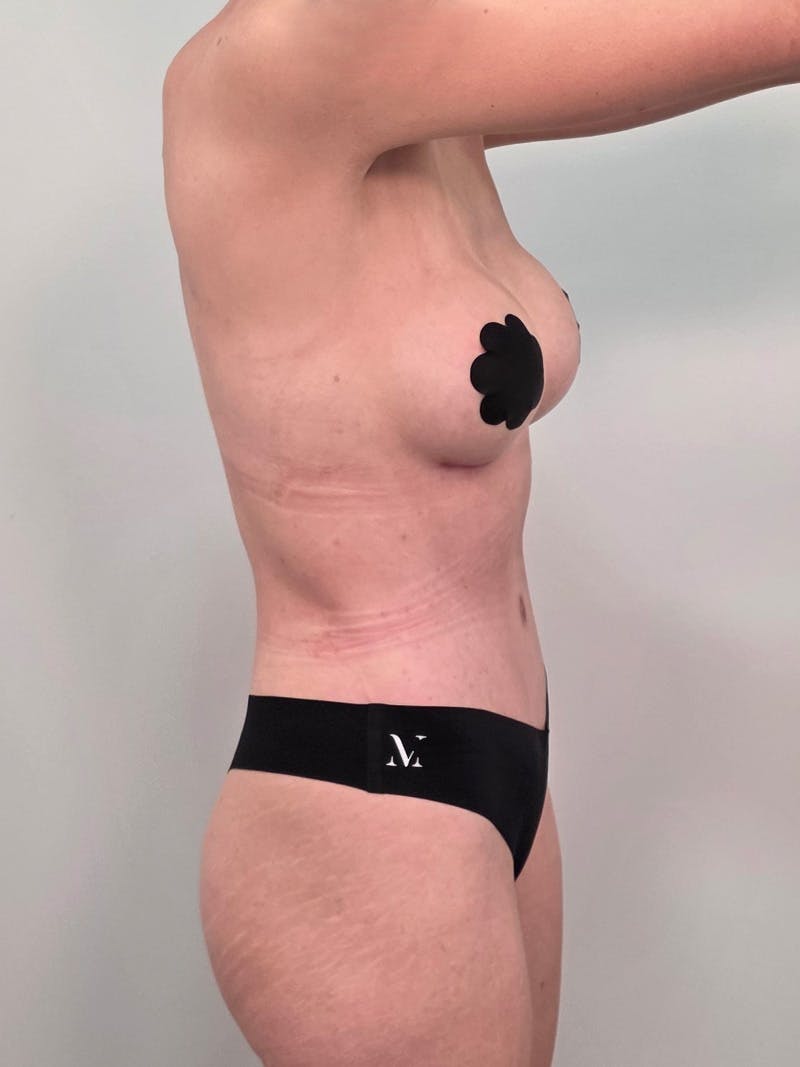 Mommy Makeover Before & After Gallery - Patient 320567 - Image 8