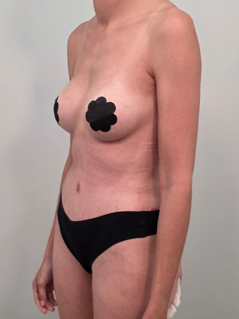 Mommy Makeover Before & After Gallery - Patient 320567 - Image 10