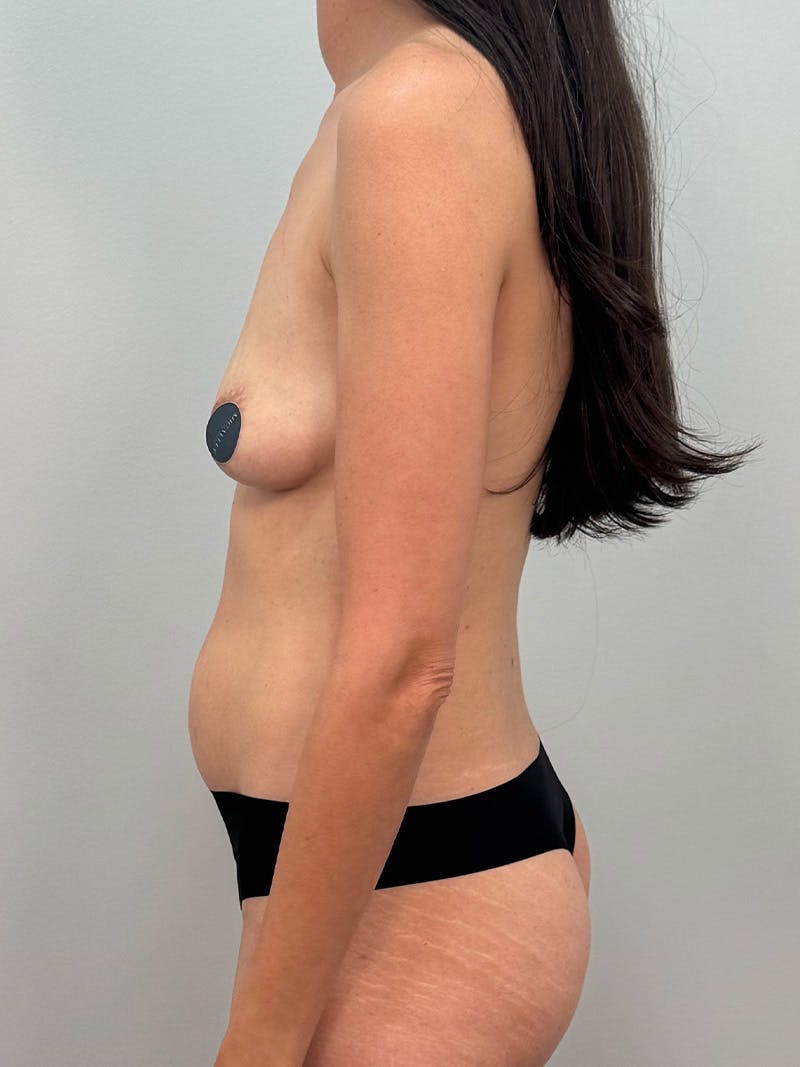 Mommy Makeover Before & After Gallery - Patient 320567 - Image 11