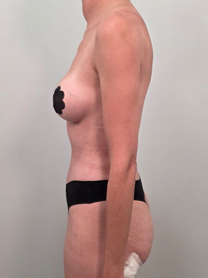 Mommy Makeover Before & After Gallery - Patient 320567 - Image 12