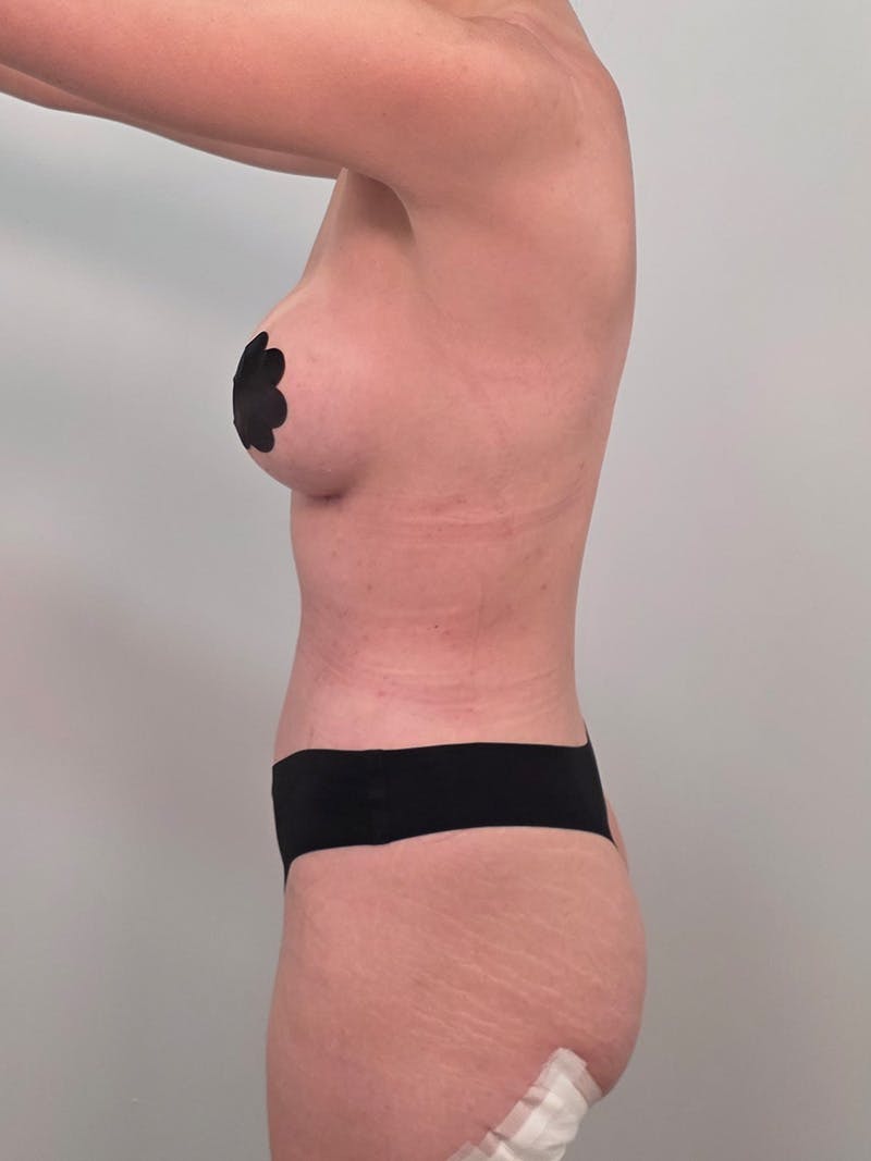 Mommy Makeover Before & After Gallery - Patient 320567 - Image 14