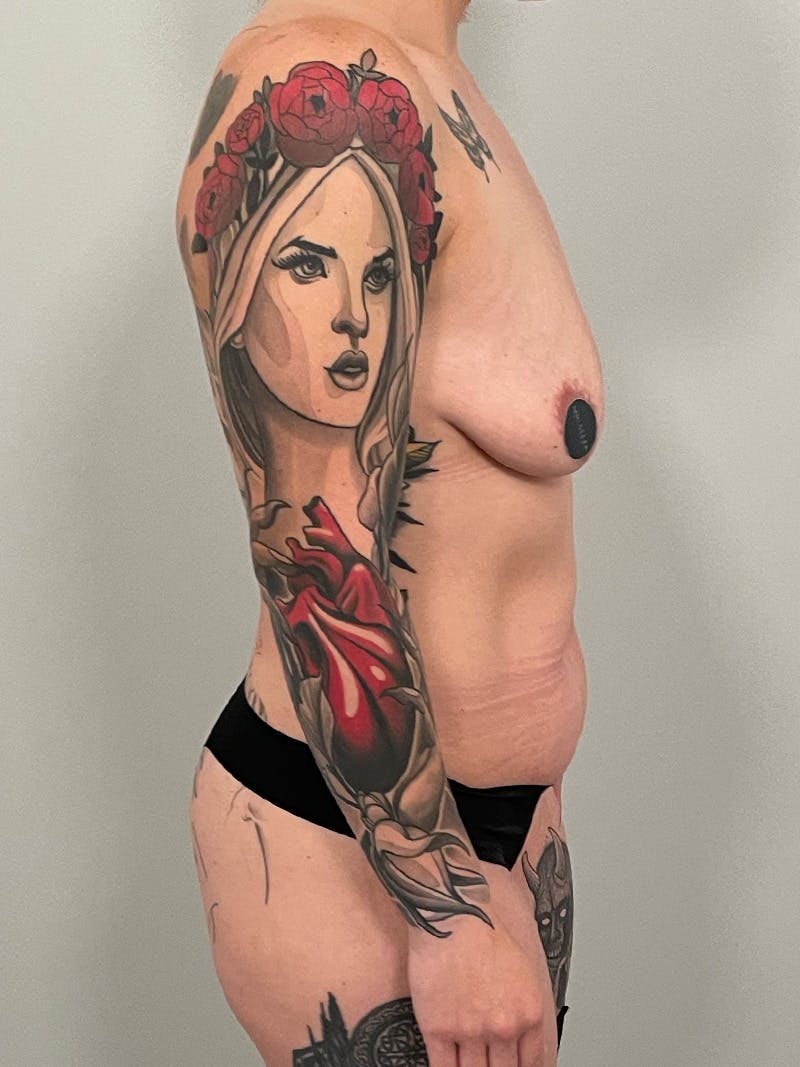 Mommy Makeover Before & After Gallery - Patient 320461 - Image 5