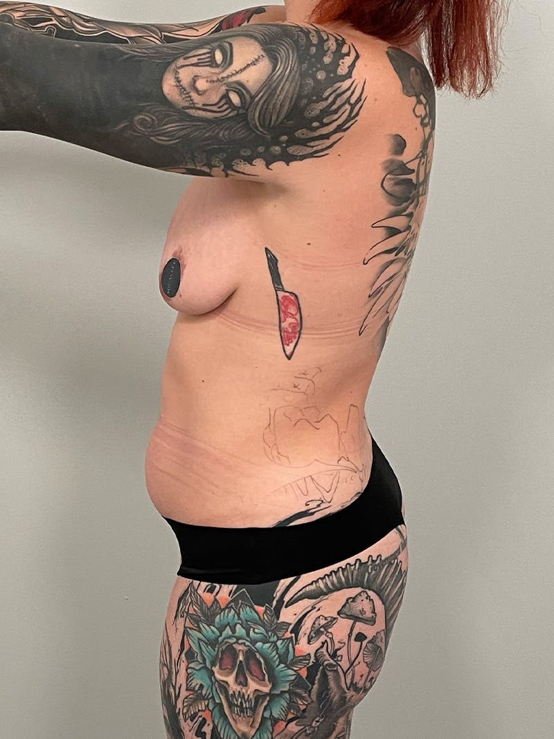 Mommy Makeover Before & After Gallery - Patient 320461 - Image 13