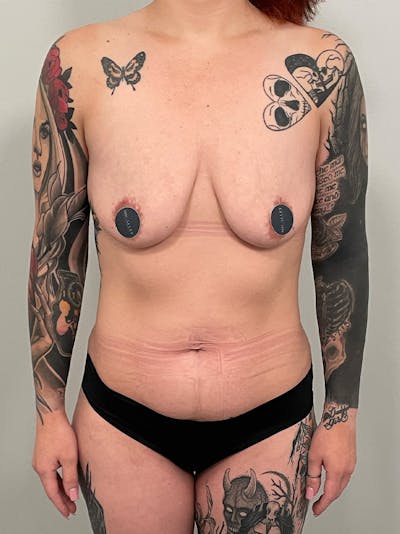 Mommy Makeover Before & After Gallery - Patient 320461 - Image 1