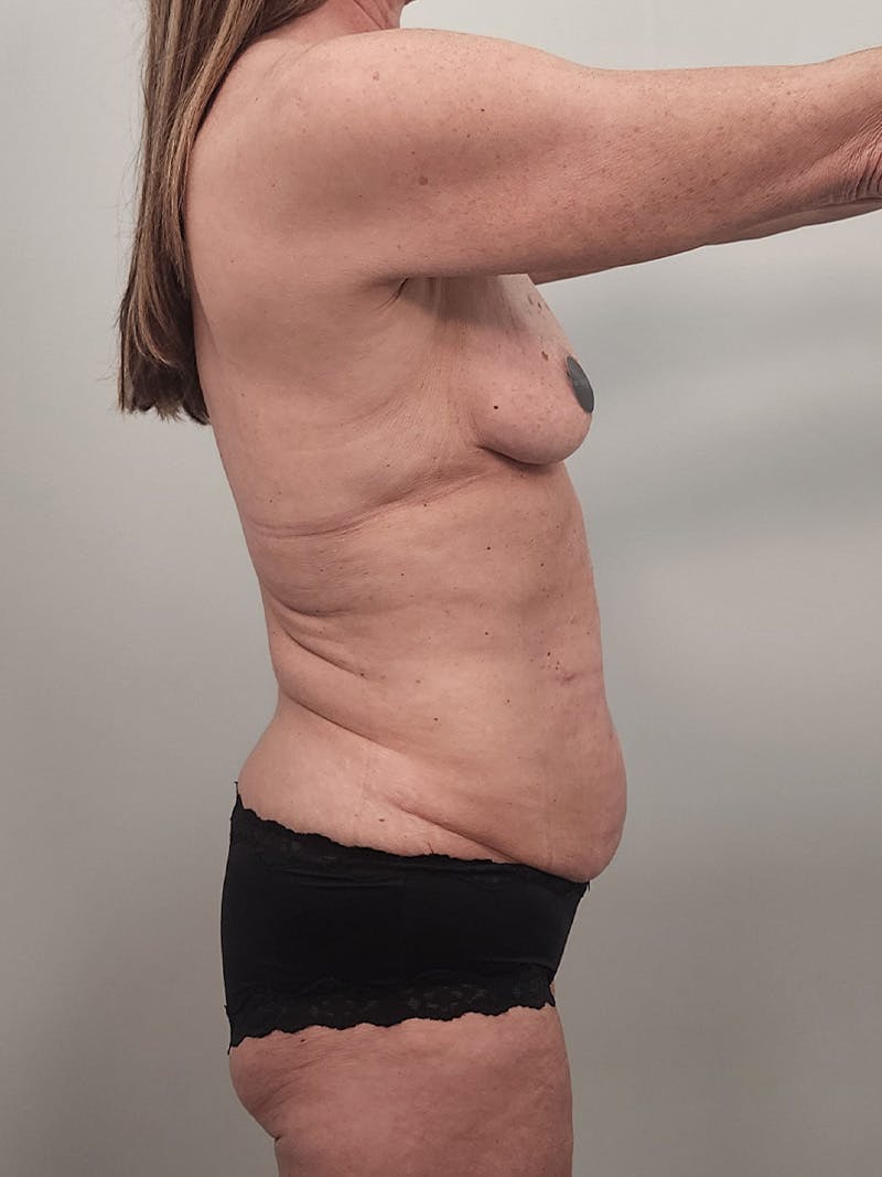 Mommy Makeover Before & After Gallery - Patient 396885 - Image 7