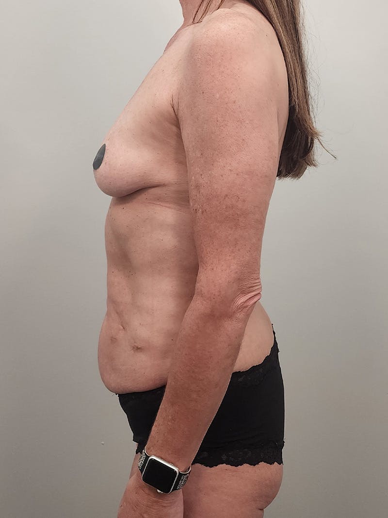 Mommy Makeover Before & After Gallery - Patient 396885 - Image 11