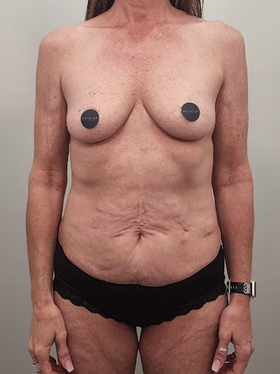 Mommy Makeover Before & After Gallery - Patient 396885 - Image 1