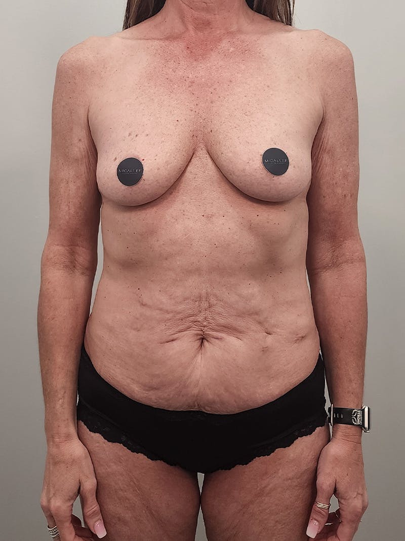 Mommy Makeover Before & After Gallery - Patient 396885 - Image 1