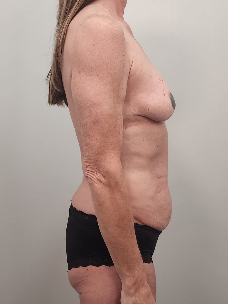 Mommy Makeover Before & After Gallery - Patient 396885 - Image 5