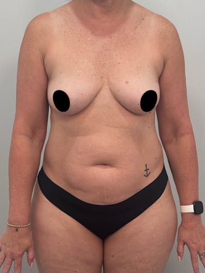 Mommy Makeover Before & After Gallery - Patient 187033 - Image 1