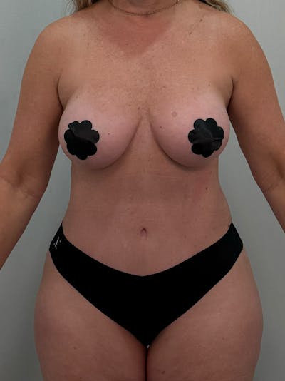 Mommy Makeover Before & After Gallery - Patient 187033 - Image 2