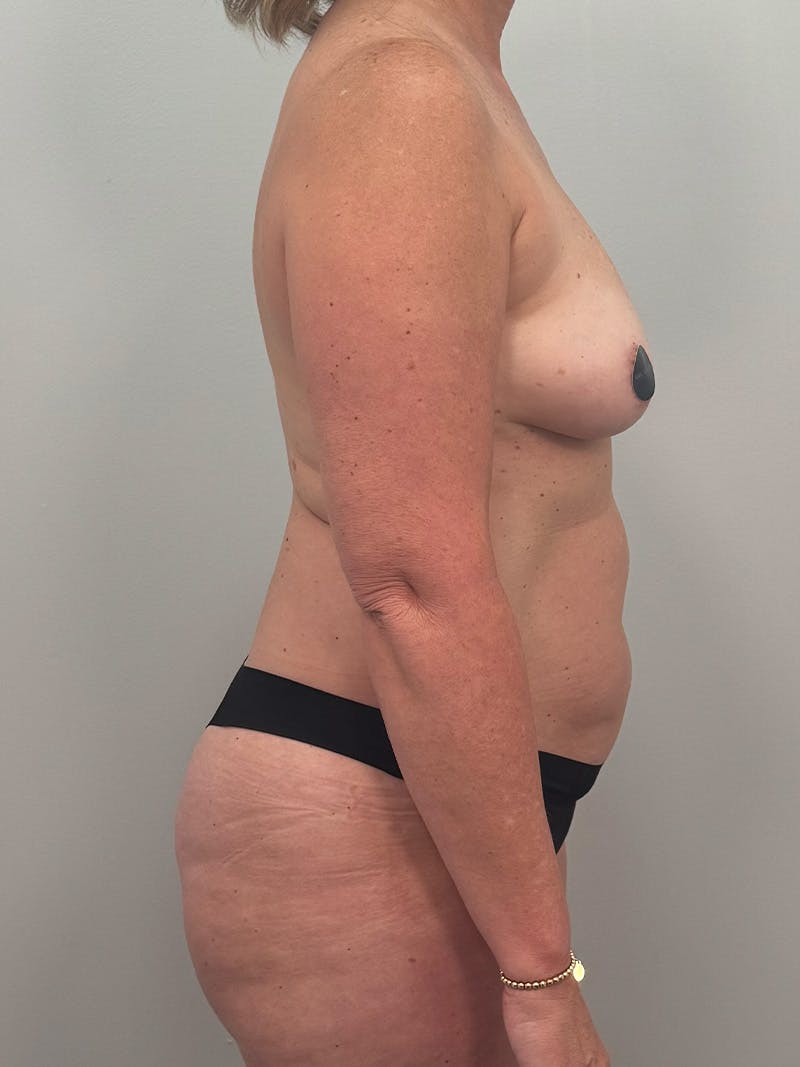 Mommy Makeover Before & After Gallery - Patient 187033 - Image 5