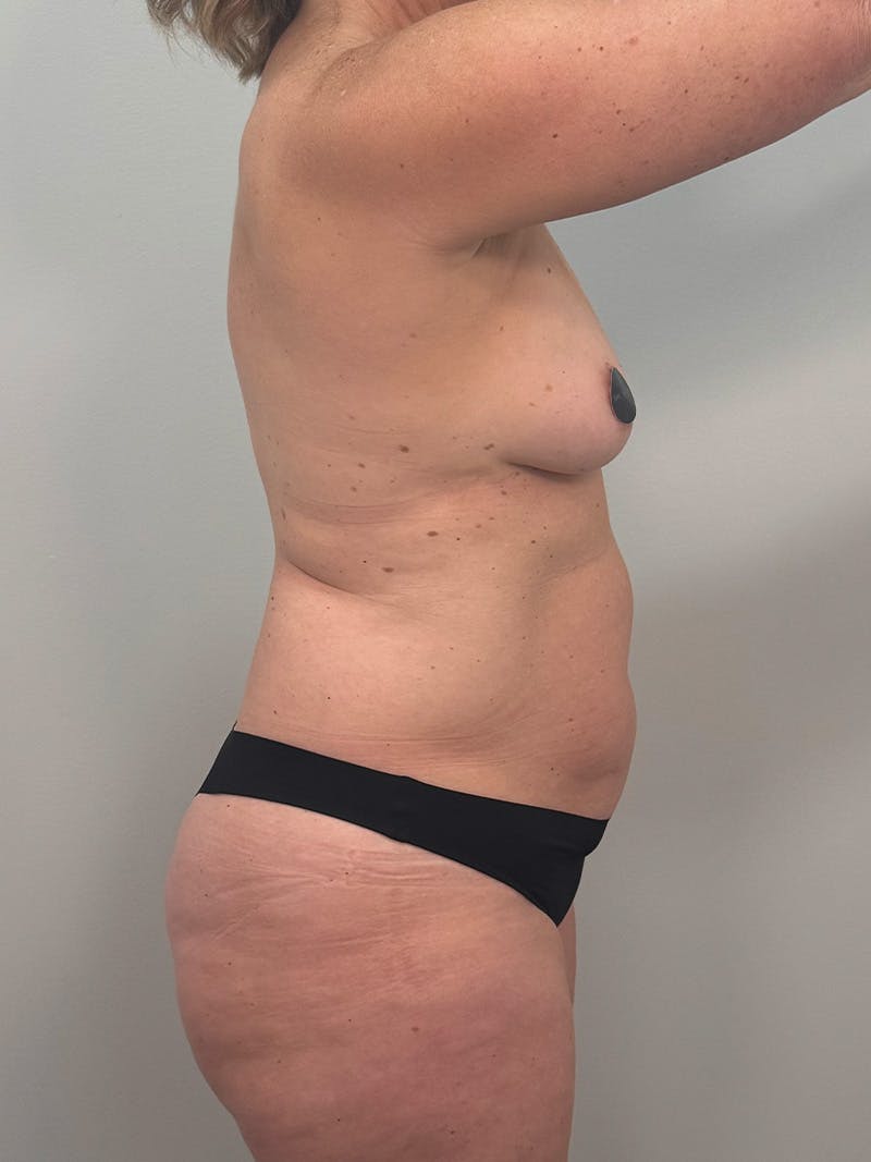 Mommy Makeover Before & After Gallery - Patient 187033 - Image 7