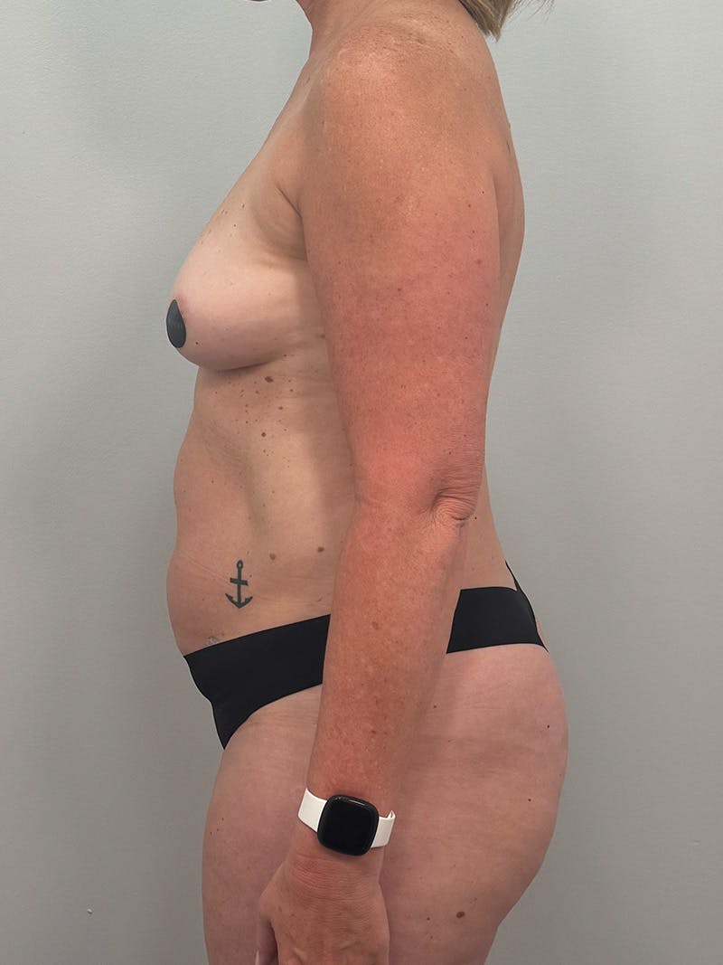 Mommy Makeover Before & After Gallery - Patient 187033 - Image 13