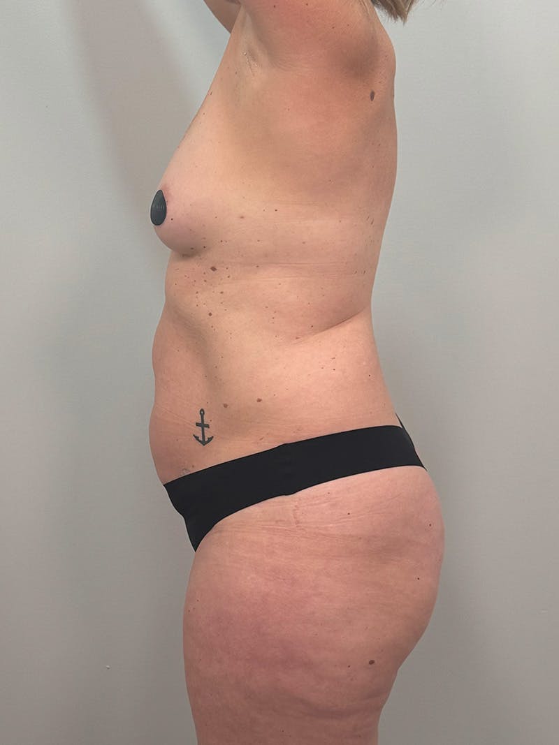 Mommy Makeover Before & After Gallery - Patient 187033 - Image 11