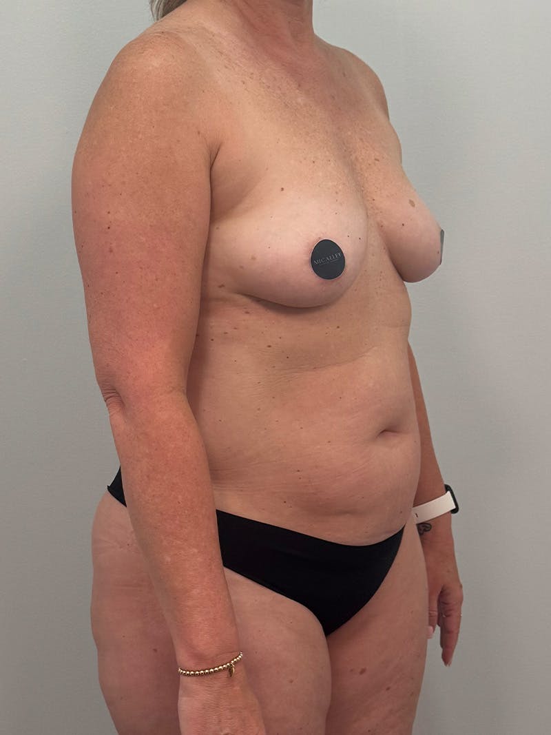 Mommy Makeover Before & After Gallery - Patient 187033 - Image 3