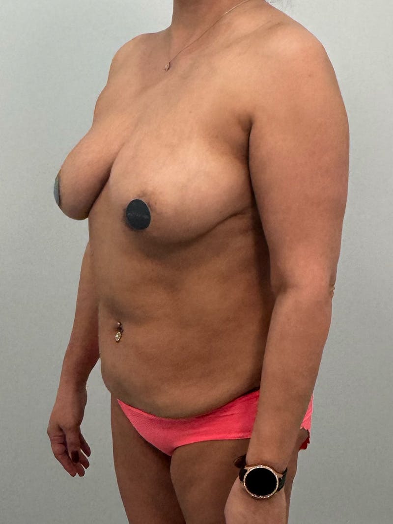 Mommy Makeover Before & After Gallery - Patient 293689 - Image 9